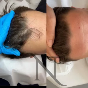 Découvrez les résultats du PRP cheveux contre la perte de cheveux. Comparez-le aux greffes capillaires et prenez rendez-vous pour votre traitement dès maintenant !