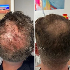 Découvrez comment le PRP stimule la repousse des cheveux naturellement. Comparaison avec la greffe et conseils d’experts