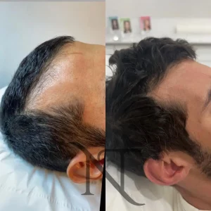 : Greffes capillaires : une solution durable contre la perte de cheveux. Découvrez aussi le PRP pour optimiser les résultats.