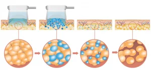 Illustration scientifique de l'apoptose des adipocytes par le froid lors d'une l'intervention de Lipocryolyse