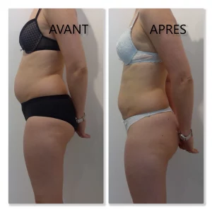une photo qui mets en avant l'utilisation de la machine pour la cryolipolyse avant apres d'une cliente de niptuck clinic